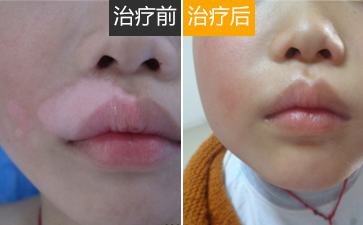 该怎么治疗儿童白癜风