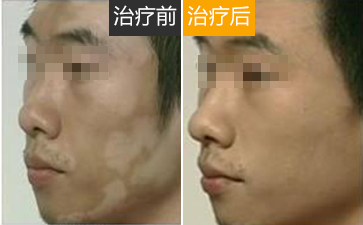 应该如何正确治疗白癜风